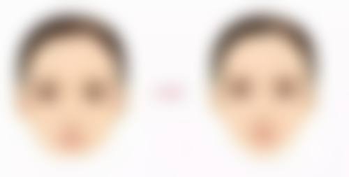 不同自体脂肪填充项目对比