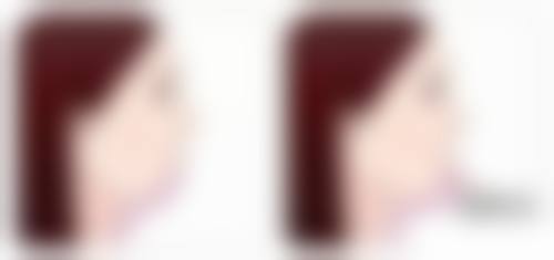 头发种植毛囊多久可以稳定下来？