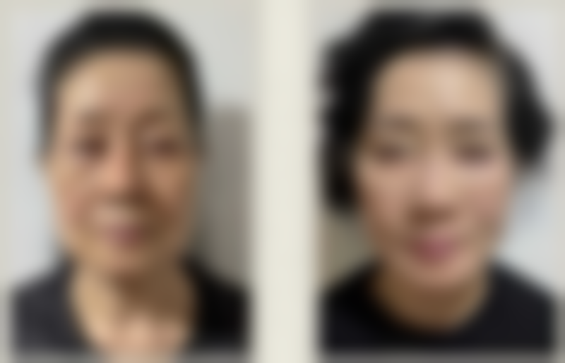 头发种植毛囊多少钱？