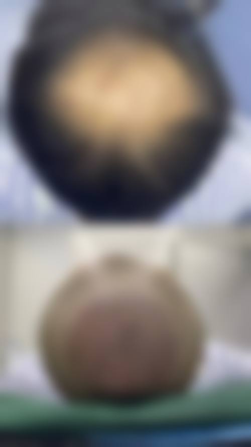 【兰州新禾植发参考价格表：】