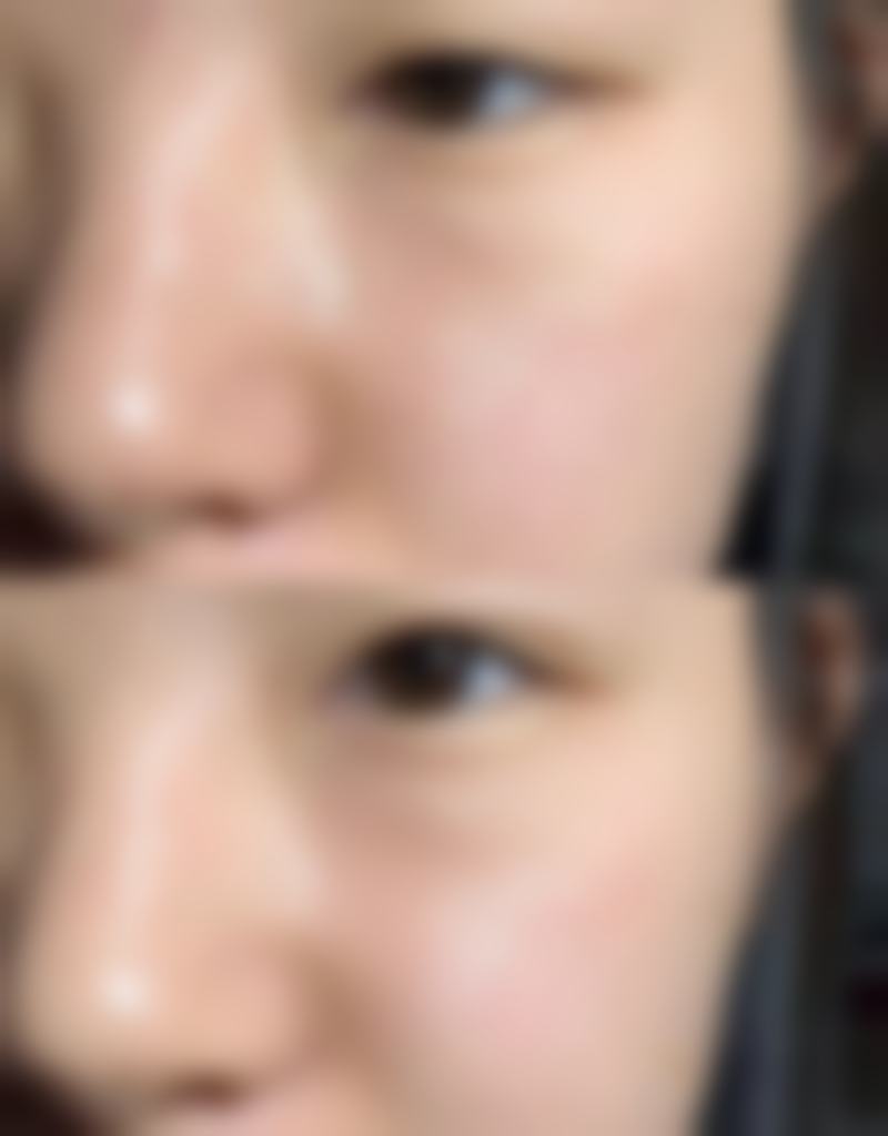 瘦脸针打一次可以完全修复吗