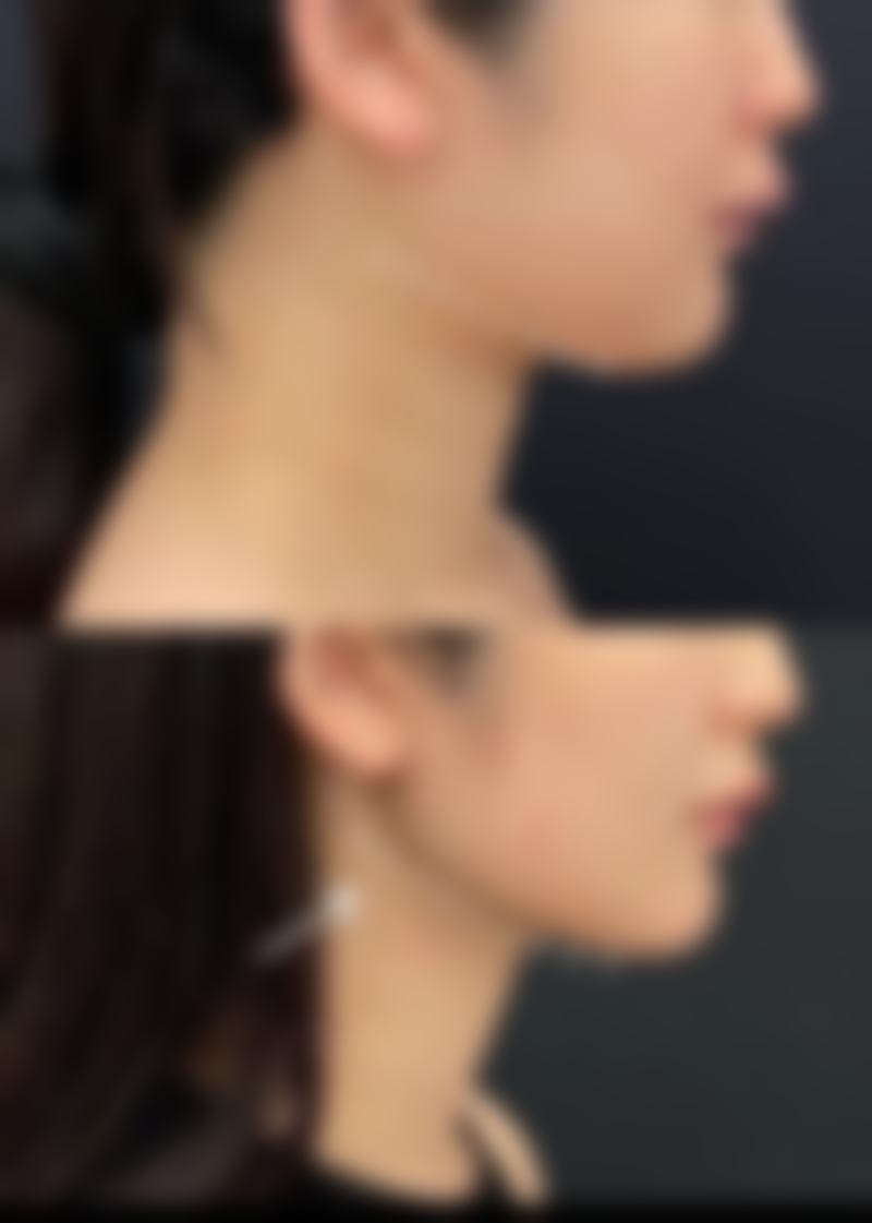 打一次瘦脸针成效明显吗