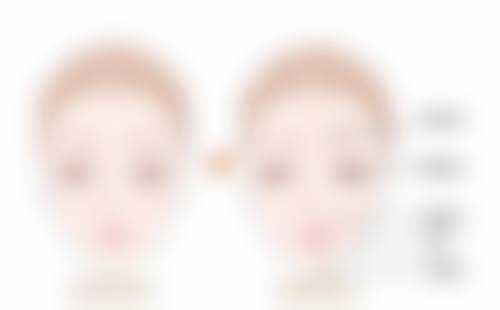 阴道紧缩术好吗