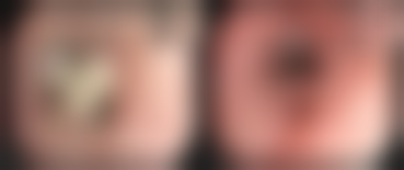 【聊城青悦整形医院患者口碑评价：】