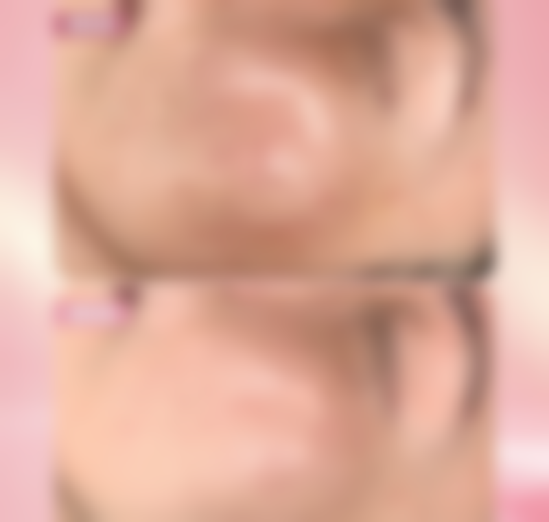 面部除皱针安全吗？权威解析其安全性，90%适用人群反馈良好，正规操作下风险低可放心尝试！ 