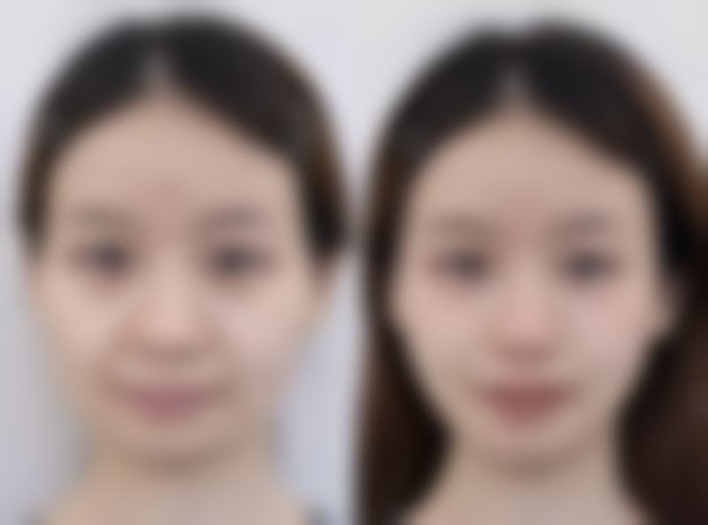 阴道紧缩术有什么影响