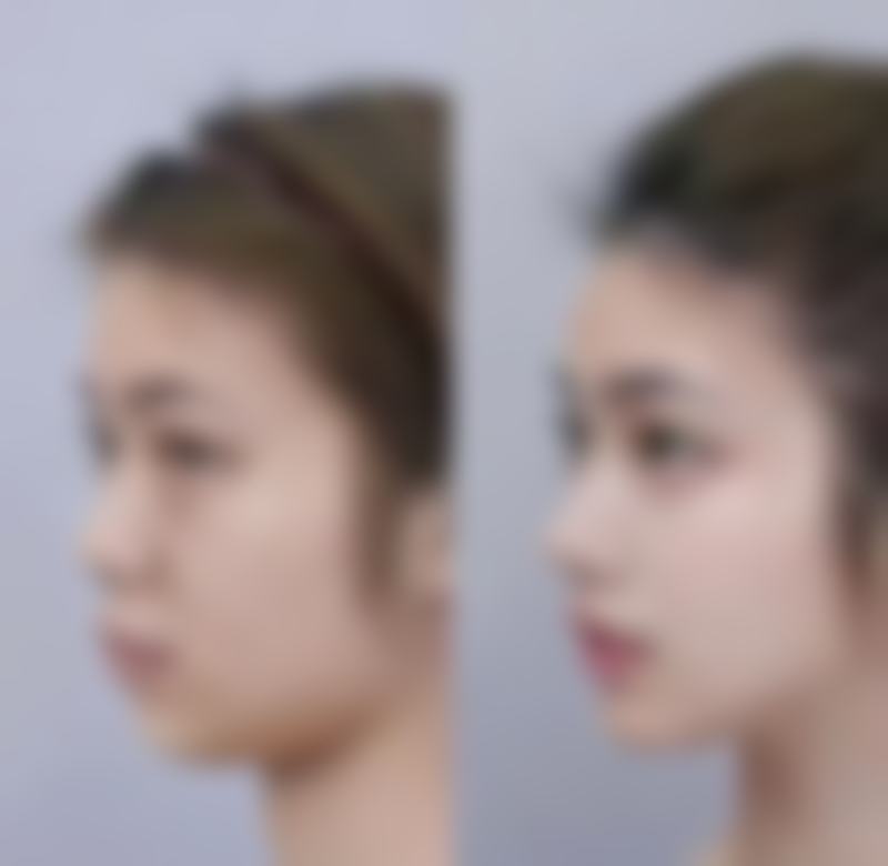 瘦脸针哪里打比较正规