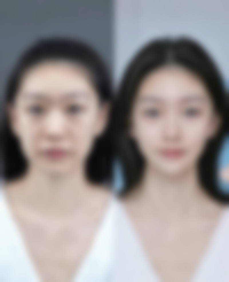 打瘦脸针的注意事项