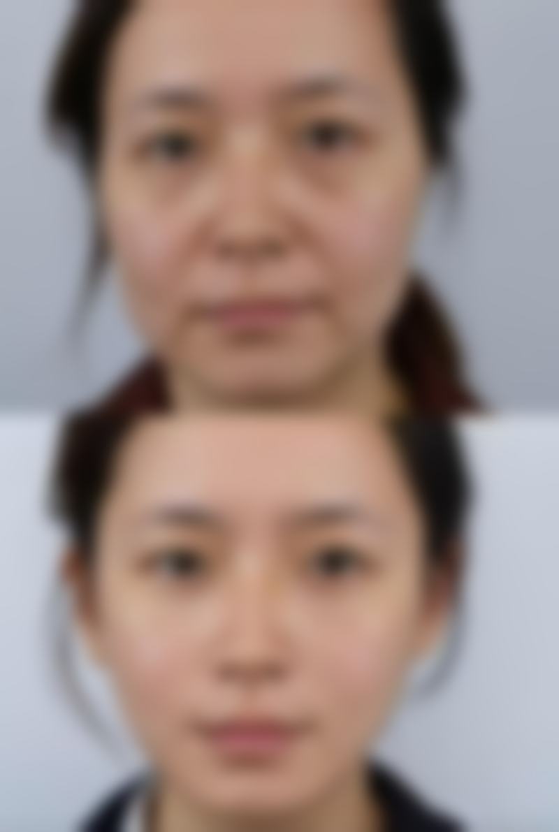 面部除皱针价格是多少