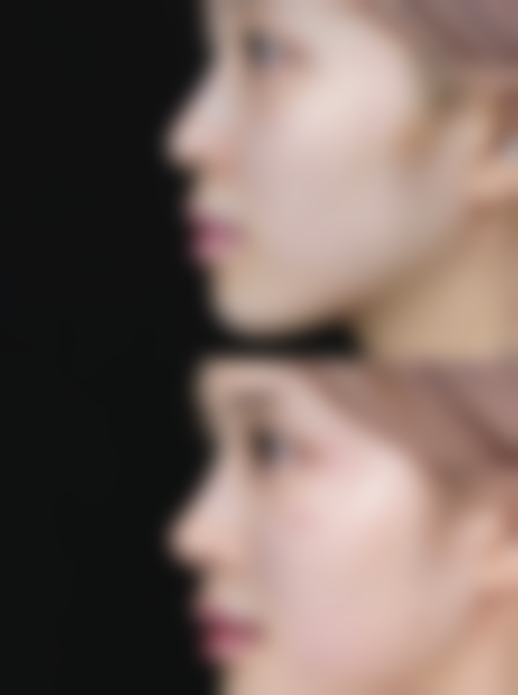 阴道紧缩术有效吗