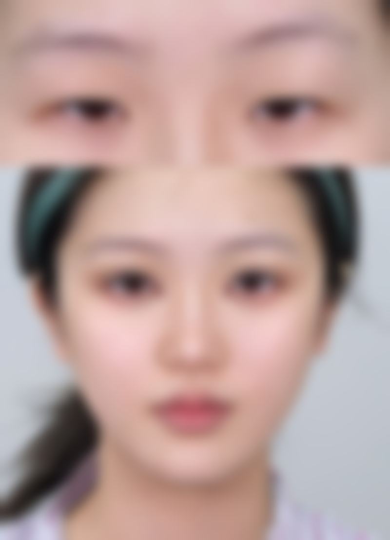 瘦脸针打一次维持多久