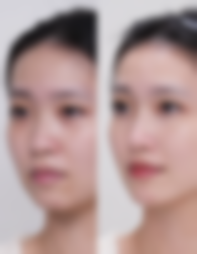 瘦脸针的危害和副作用