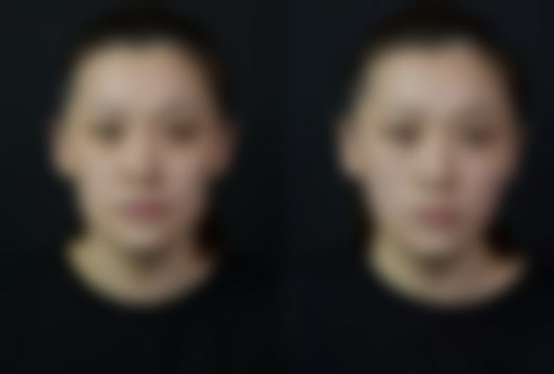 面部除皱针注射部位图