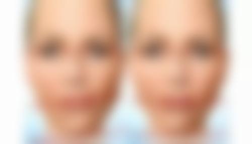 打一针瘦脸针有副作用吗