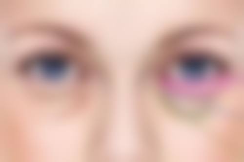 玻尿酸丰太阳穴与其他填充方式的比较