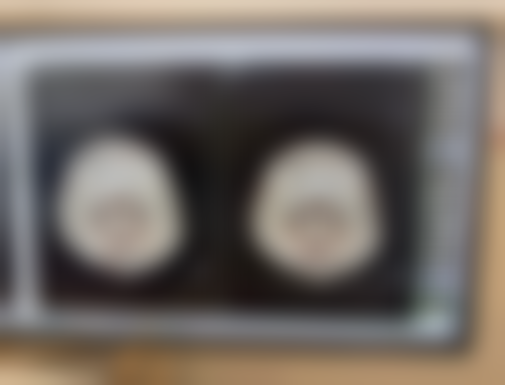 打一针瘦脸针能修复到原来吗