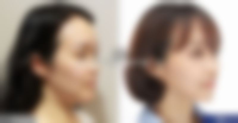除皱针能除掉法令纹吗