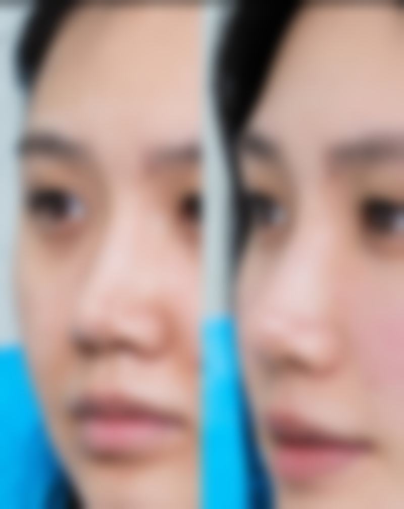未成年可以做瘦脸针吗