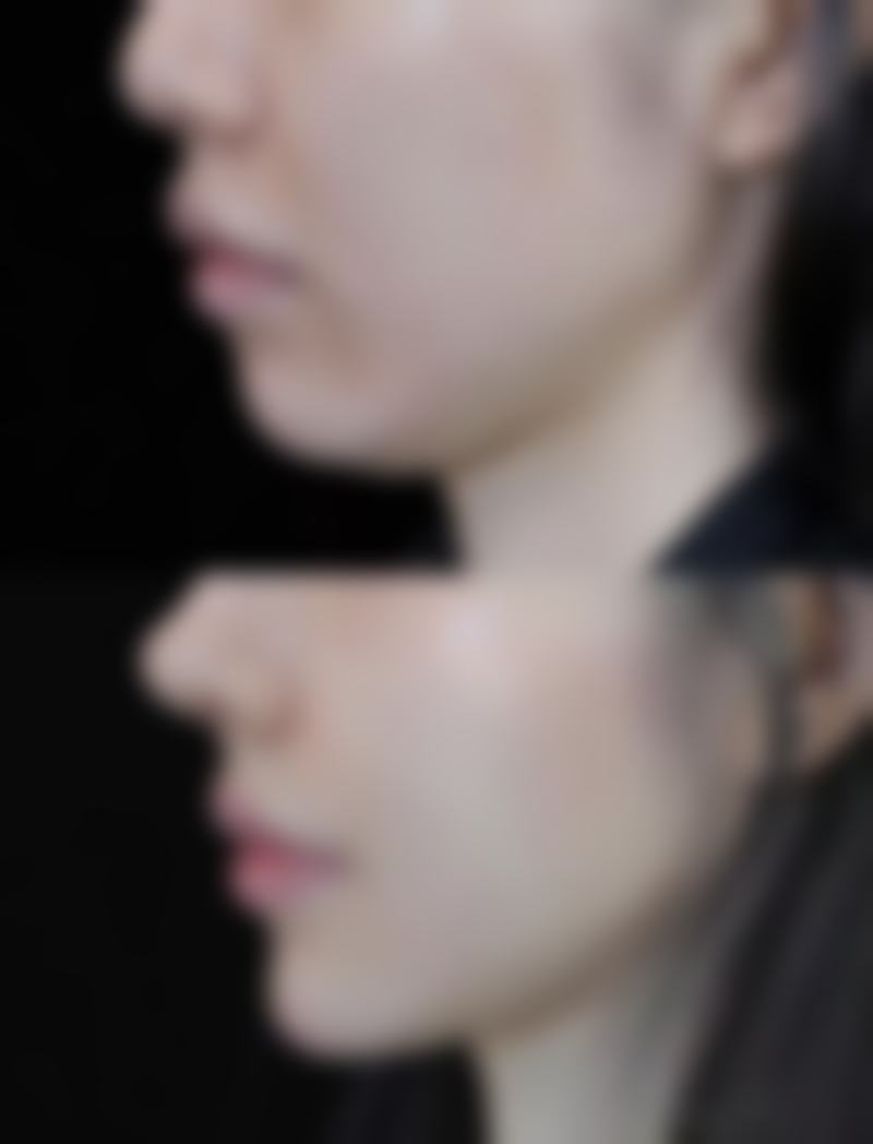 瘦脸针没成年可以打吗