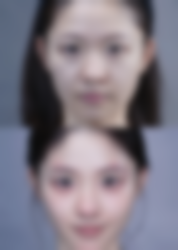 皮肤弹性降低失去光泽出现皱纹