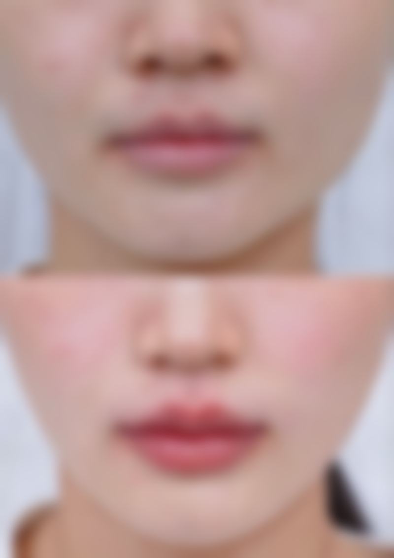 打了除皱针喝了酒会怎样
