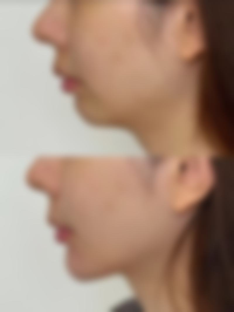 嘴巴歪吃什么药更有效
