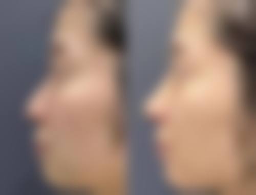 骨性凸嘴矫正多大年龄比较好
