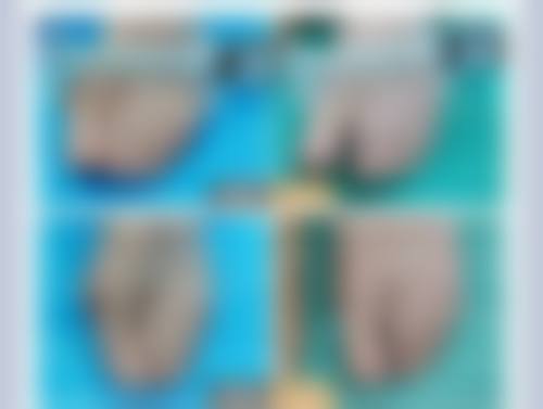 打完瘦脸针后嘴巴歪了