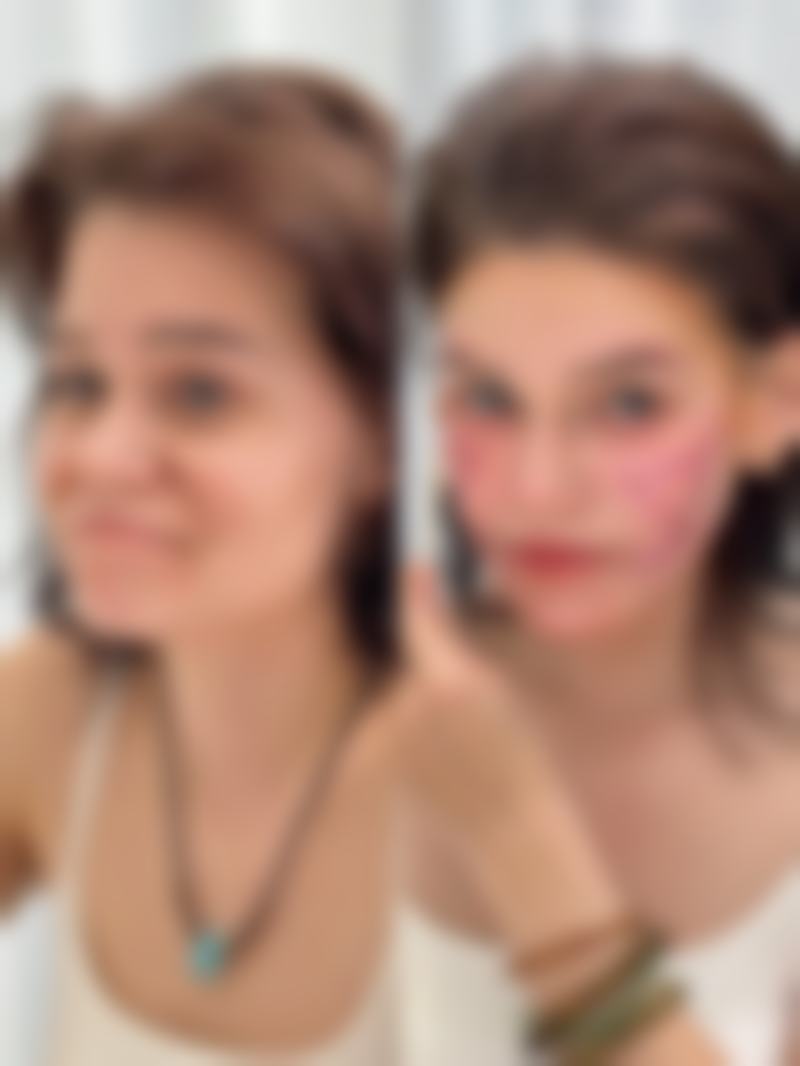 评价三:“我做了下颌角整形手术,在太原倾城医疗美容诊所。从术前的询问到术后的护理,每一个环节都特别贴心。石楠楠医生技术特别棒,术后的成效也非常自然,我特别满意这次的整形体验。”