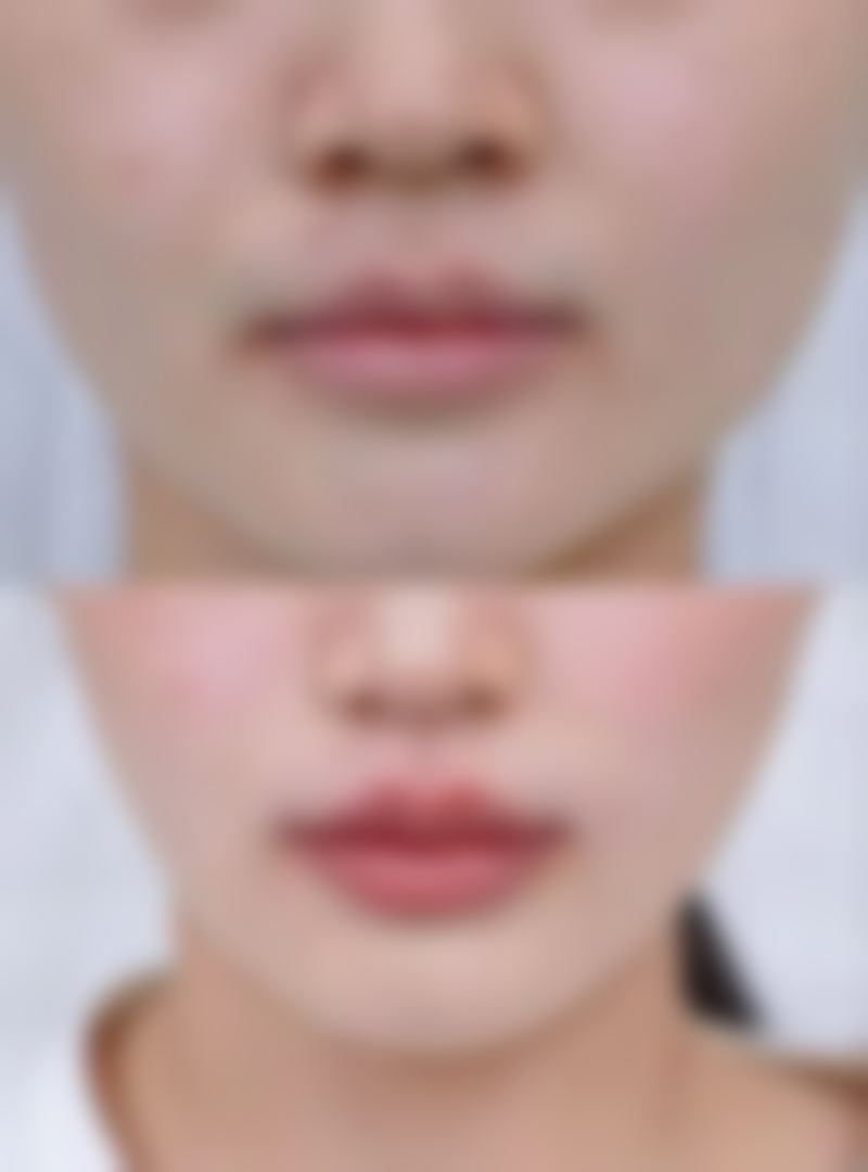 发旋能通过植发去掉吗