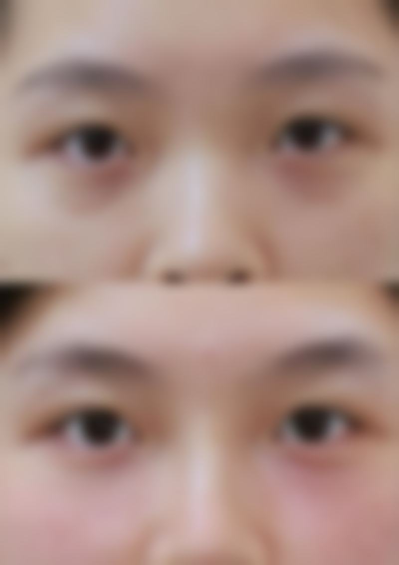 嘴唇的疤痕能修复吗图片