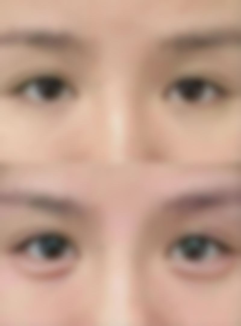 阴道紧缩术实例分享