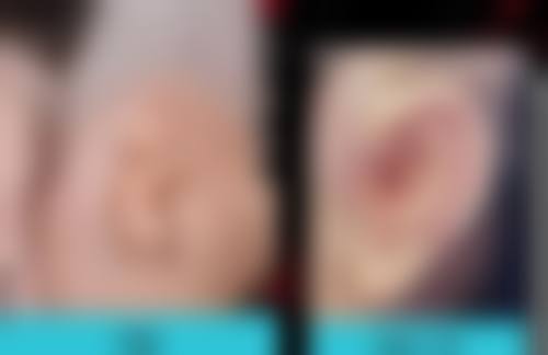 如何正确看待阴道紧缩术