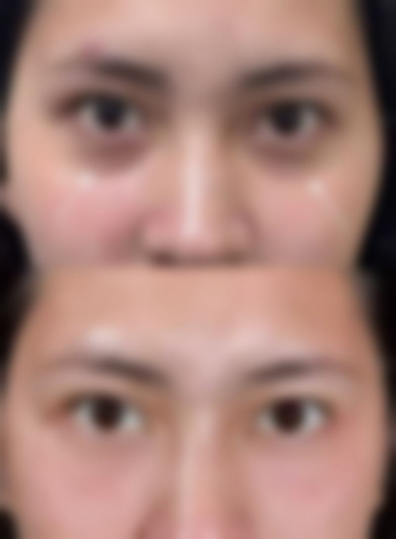美白针能去雀斑吗