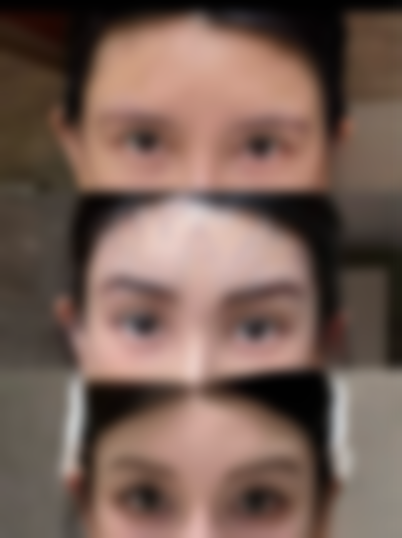 打瘦脸针有后遗症吗