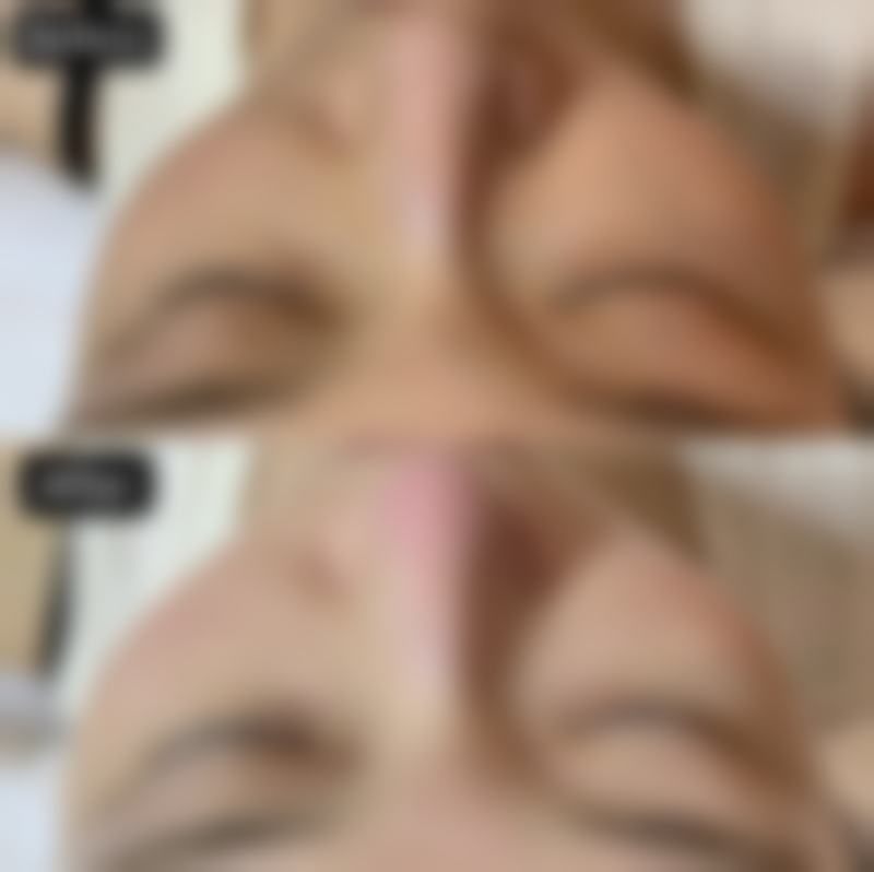 方脸打完瘦脸针