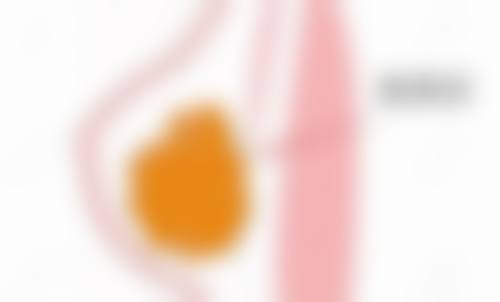 嘴唇整形对比图