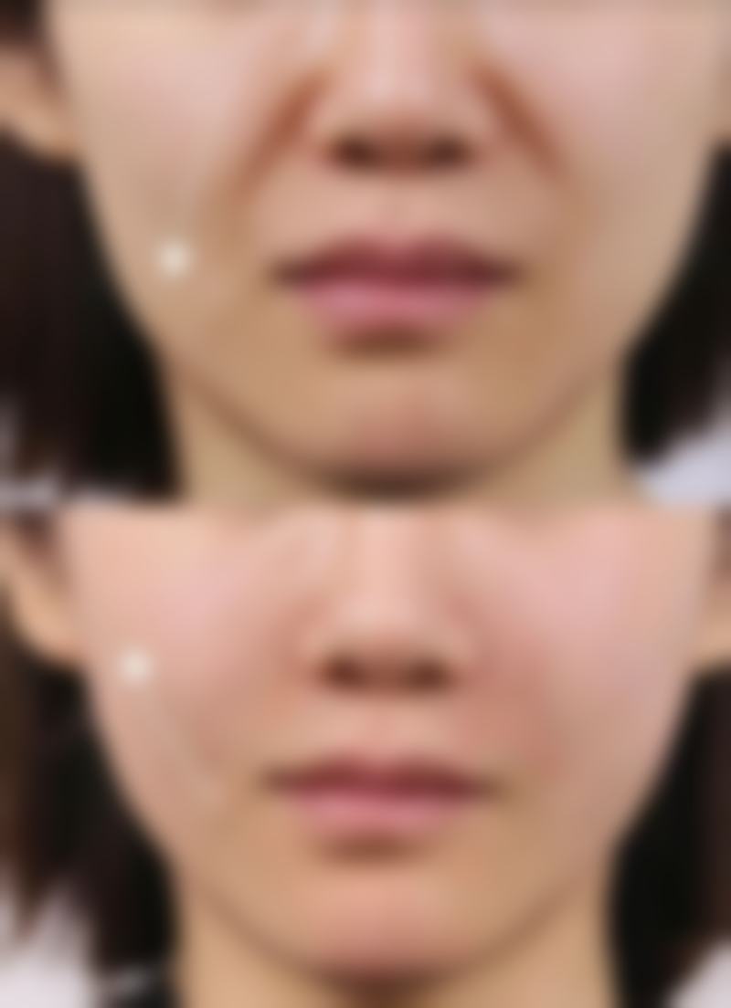 全脸除皱针能保持多久