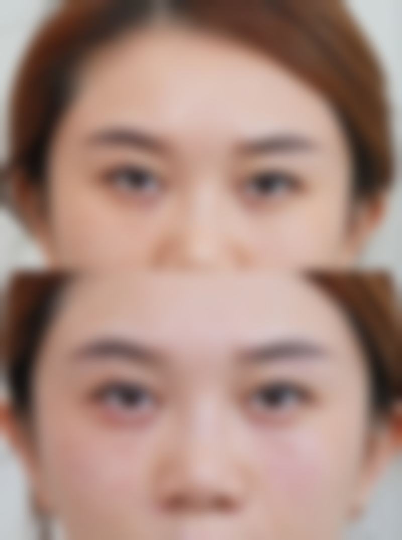 全脸打除皱针有成效吗