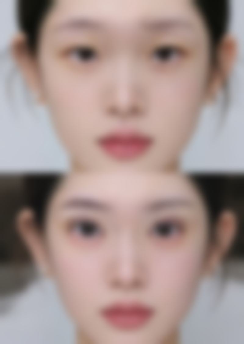 打除皱针
