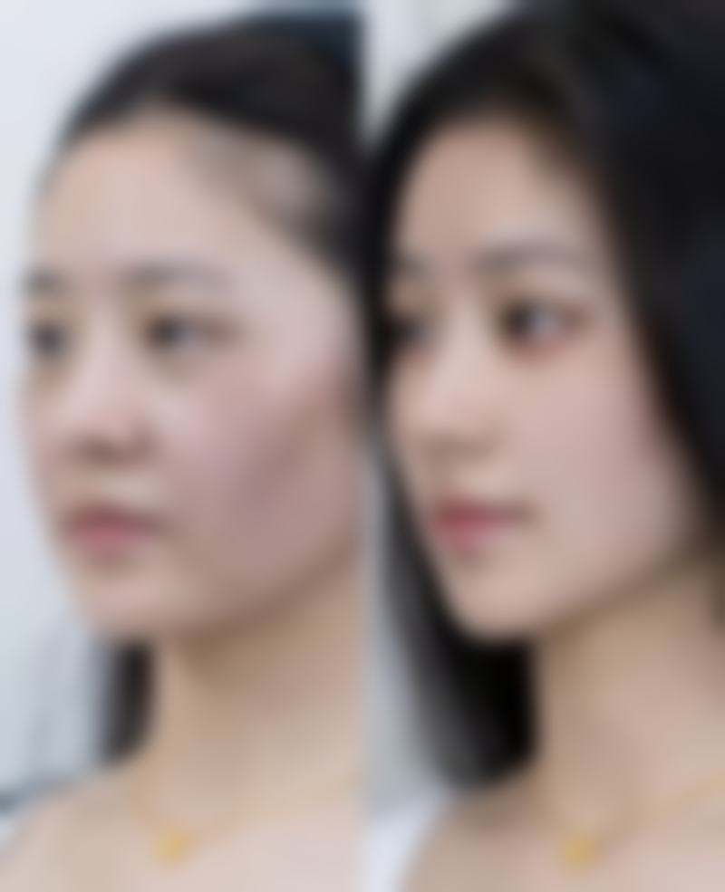 除皱针后多久可以化妆