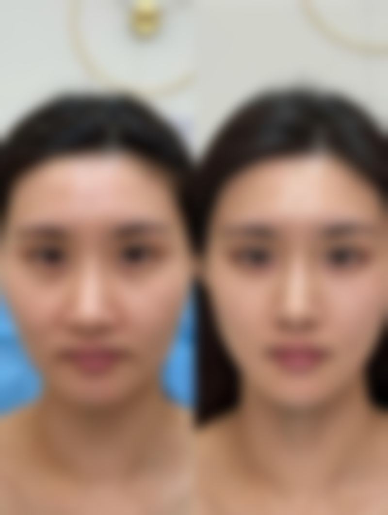 一笑嘴歪怎么矫正？揭秘3种医美矫正方法，轻松告别歪嘴烦恼，重绽自信笑容！ 