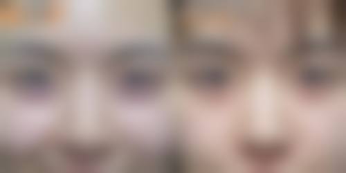 除皱针面部僵硬怎么能快速修复正常
