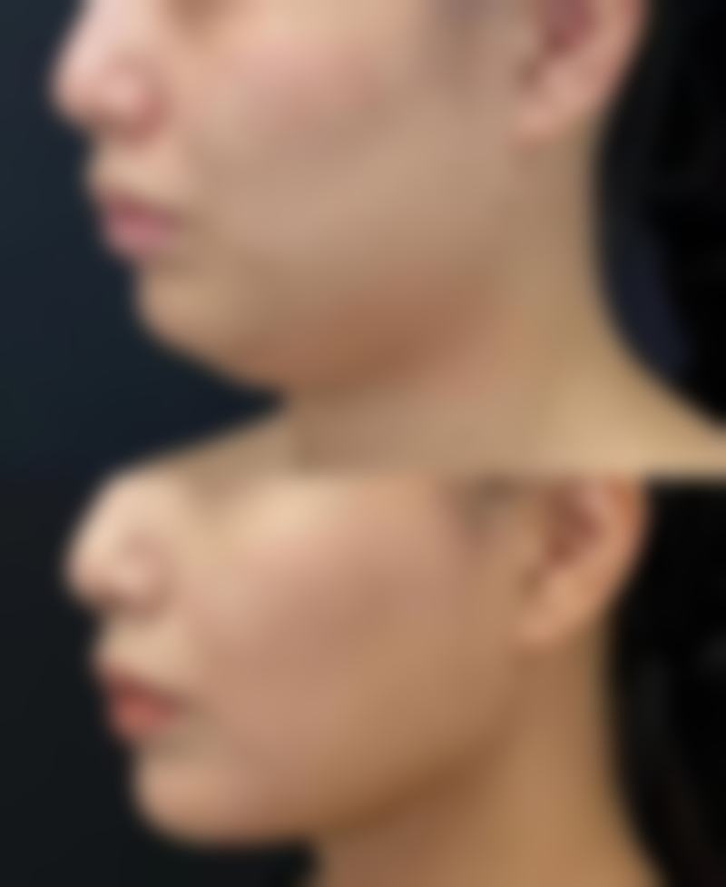 嘟嘟唇太厚了怎么办