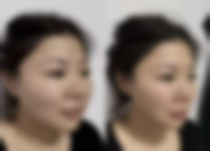 瘦脸针多久可以身体代谢掉