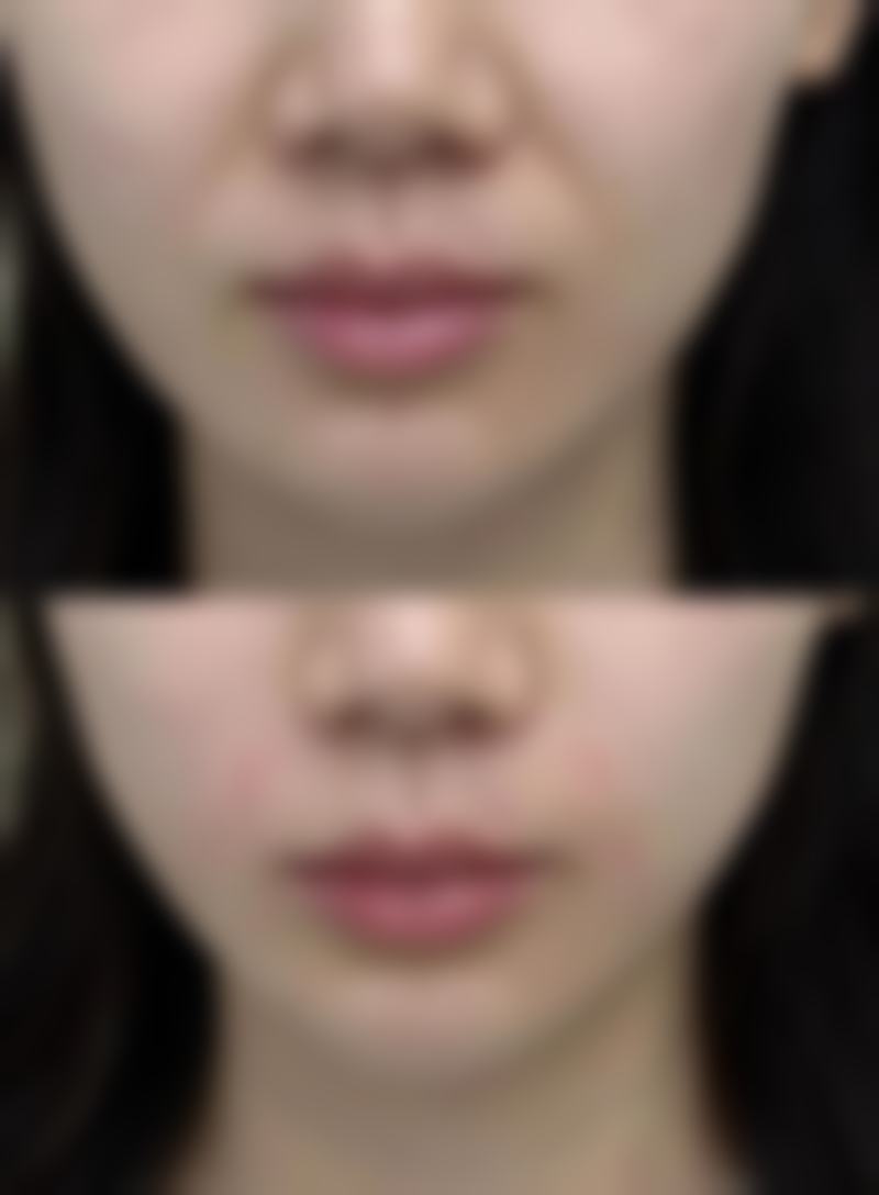 瘦脸针的危害和副作用