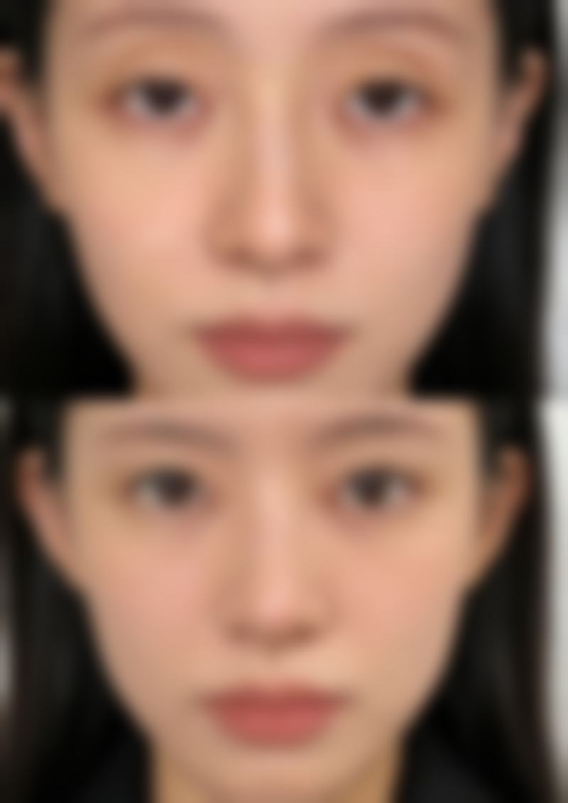 瘦脸针一般打50单位还是100单位