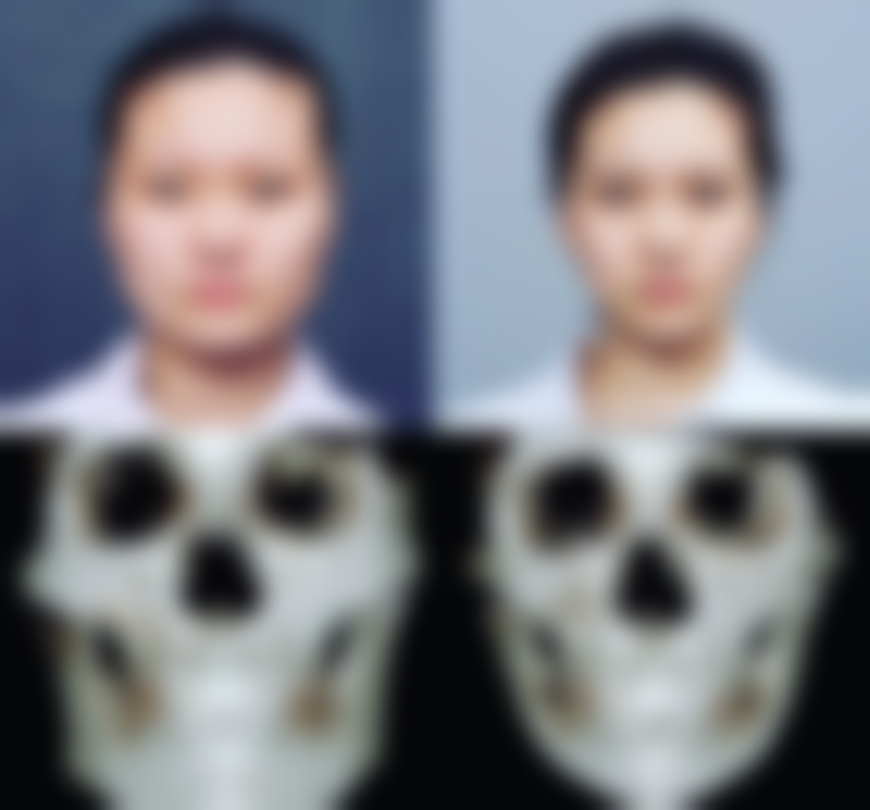 打了瘦脸针会有什么反应？揭秘3大常见反应及5种应对方法，让你轻松拥有精致小脸！ 