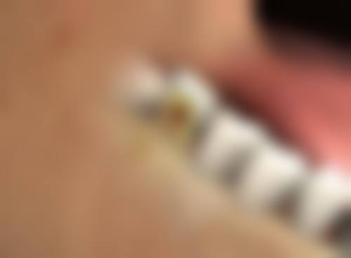 嘴凸如何怎么矫正？医美揭秘：3种主流矫正方法，效果显著，助你轻松拥有完美侧颜！ 