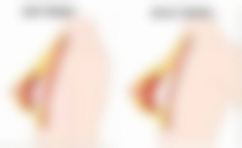 瘦脸针打一次维持多久